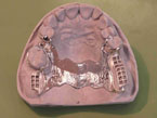 Hardt Dental-Labor: Beispiel Modellguss