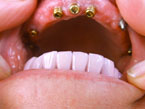 Hardt Dental-Labor: Beispiel Locatoren auf Implantaten (Oberkiefer)