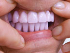 Hardt Dental-Labor: Beispiel eingesetzte Prothese