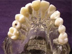 Hardt Dental-Labor: Beispiel 15 okklusal verschraubte Implantatkrone & 24-26 festsitzende Keramikbrücke