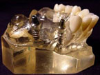 Hardt Dental-Labor: Beispiel Implantatsituation für dreigliedrige Keramikbrücke