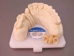 Hardt Dental-Labor: Beispiel Beispiel 13-15 dreigliedrige Vollkeramikbrücke